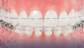 Sistema Damon en clínicas Ortodoncis