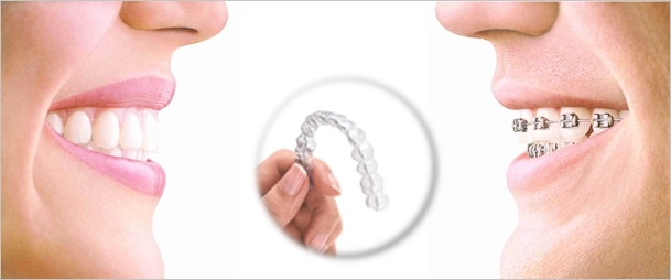 Invisalign en clínicas Ortodoncis