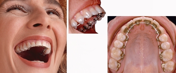 Ortodoncia lingual clínicas Ortodoncis