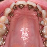 Colocación de brackets linguales invisibles