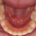 Dientes inferiores alineados con técnica lingual
