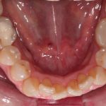 Apiñamiento dental inferior previo a tratamiento invisible