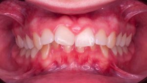tratamiento clase II con avance mandibular
