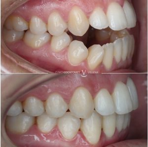 Tratamiento combinado de ortodoncia con alineadores y cirugía ortognática 