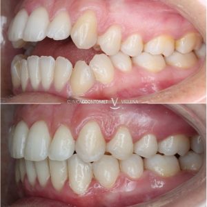 Tratamiento combinado de ortodoncia con alineadores y cirugía ortognática