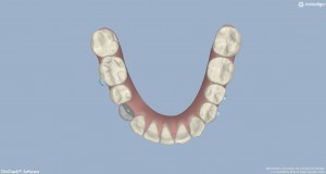 Clin-check_Oclusal_Inferior_Final