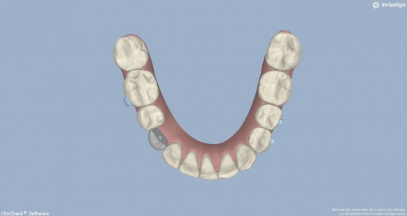 Clin-check_Oclusal_Inferior_Final