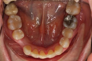 Foto oclusal inferior