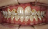 Dientes con caries COped Ortodoncia Mallorca