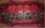 Inflamacion de encias en un caso de ortodoncia COPed Ortodoncia